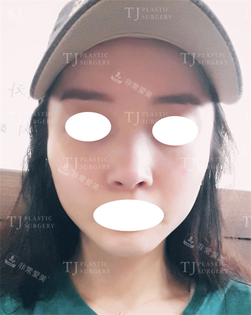韓國TJ整形外科鼻翼縮小術(shù)前圖