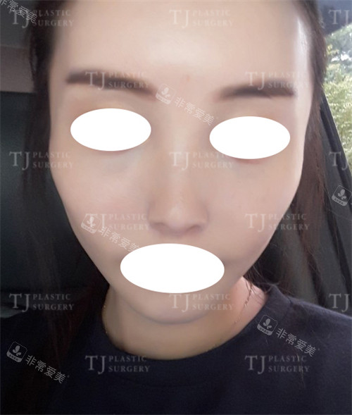 韩国TJ整形外科鼻翼缩小术后图