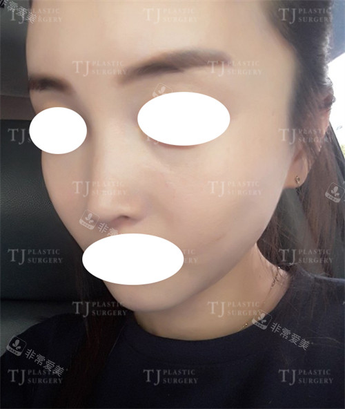 韩国TJ整形外科鼻翼缩小术后照片
