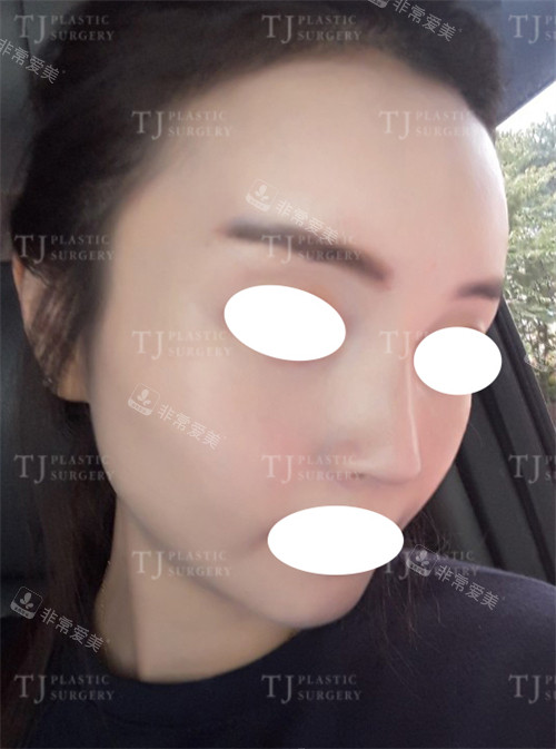 韩国TJ整形外科鼻翼缩小术后图片