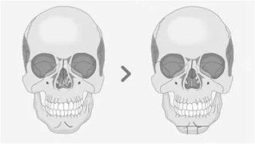 顴骨縮小動畫模擬圖