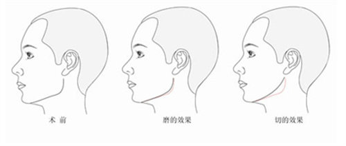 下颌角磨骨与截骨区别图