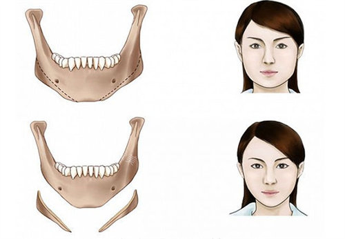 下颌角截骨前后对比图