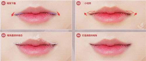 韩国现代美学整形唇部整形宣传图