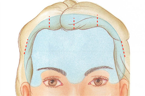 韩国歌柔飞整形额头提升定位图