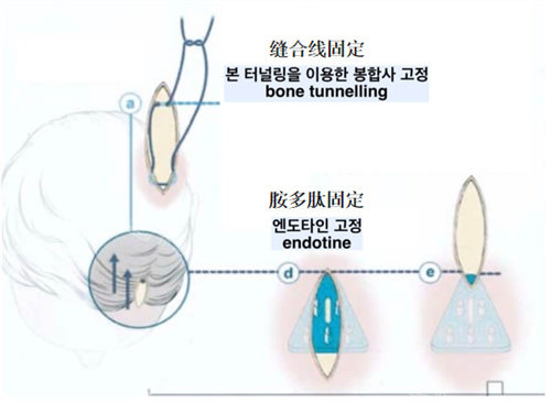 韩国额头提升哪家好?做过都推荐韩国歌柔飞内窥镜额头提升~