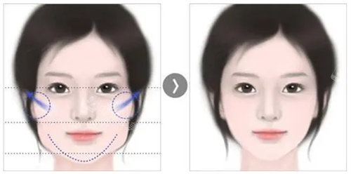 面部轮廓手术前后对比图