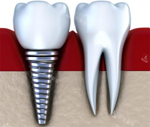 北京斯迈尔口腔种植牙采集价格表,韩国种植牙一颗3070元起!
