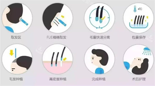 发际线种植流程展示图 发际线种植流程展示图