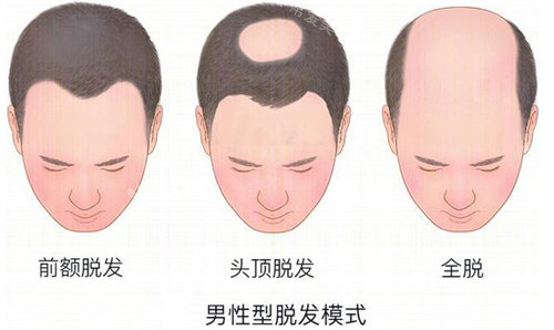 男性脱发模型参考图 男性脱发模型参考图