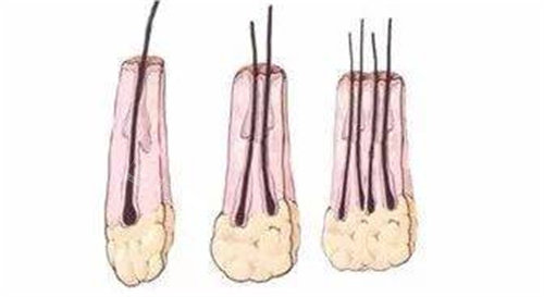 头发毛囊种植动画图