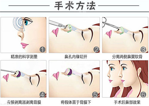 隆鼻手术方法说明图 隆鼻手术方法说明图