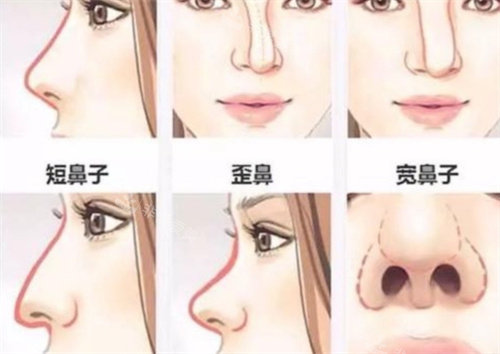 不漂亮的鼻子形态展示图 不漂亮的鼻子形态展示图