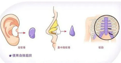 自体软隆鼻流程图 自体软隆鼻流程图