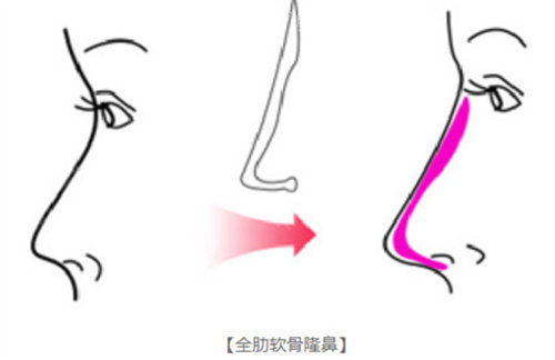 全肋软骨隆鼻动画图