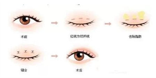 全切双眼皮手术流程图 全切双眼皮手术流程图