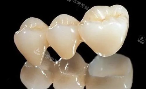 烤瓷牙示意圖 烤瓷牙示意圖