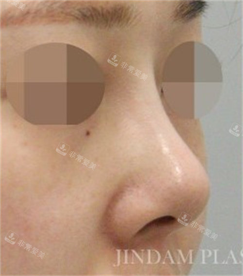 韩国真谈整形鼻修复术前图片