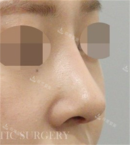 韩国真谈整形鼻修复术后图片