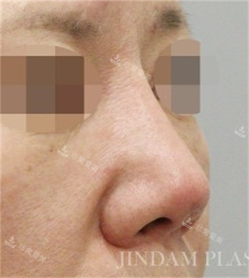 韩国真谈整形鼻修复术前图片