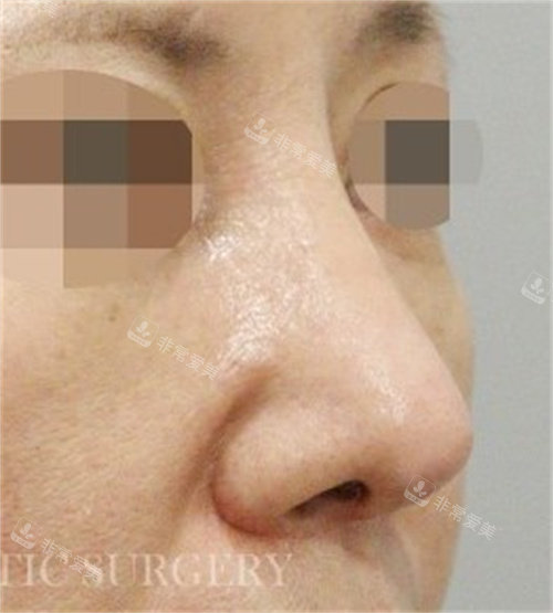 韩国真谈整形鼻修复术后图片