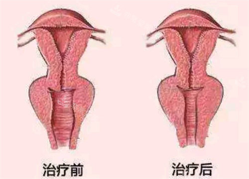 阴道紧缩治疗前后对比图