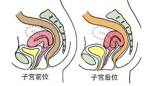 子宫前位和子宫后位对比图 子宫前位和子宫后位对比图