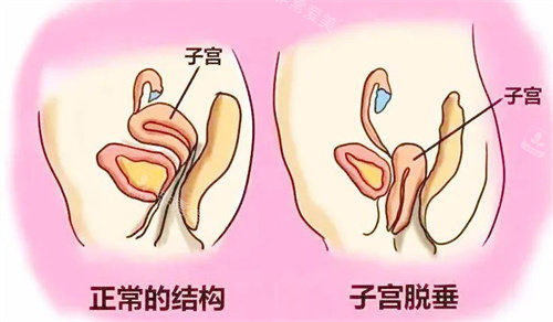 子宫脱垂与正常子宫对比图 子宫脱垂与正常子宫对比图