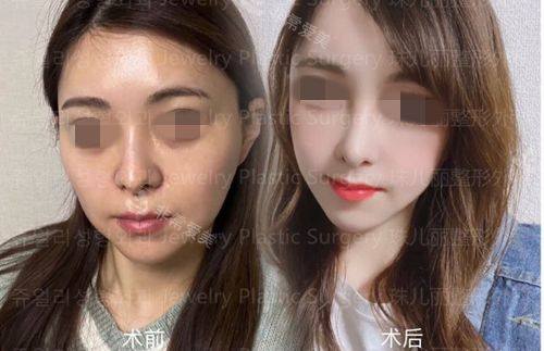 韓國珠兒麗整形外科顴骨縮小對比