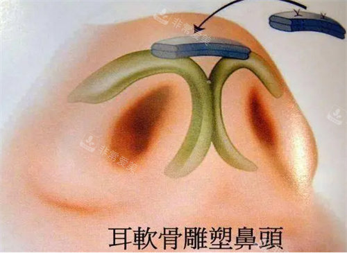 耳軟骨雕塑圖
