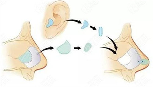 耳软骨隆鼻会吸收吗？术后可以维持多久？