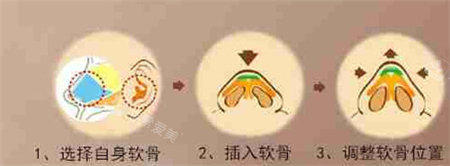 耳軟骨隆鼻方法圖