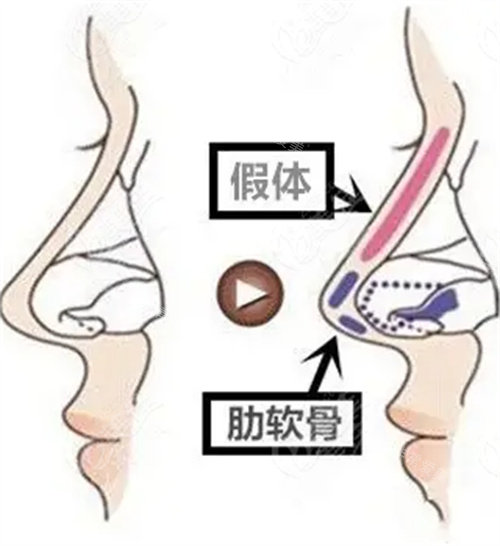 半肋骨隆鼻图