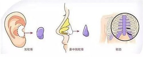 肋骨、耳软骨图