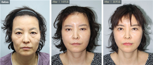 韩国现代美学整形拉皮手术对比