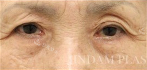 切眉提升术+眼睑下垂矫正手术前照片