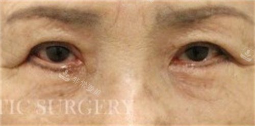 切眉提升术+眼睑下垂矫正手术后照片