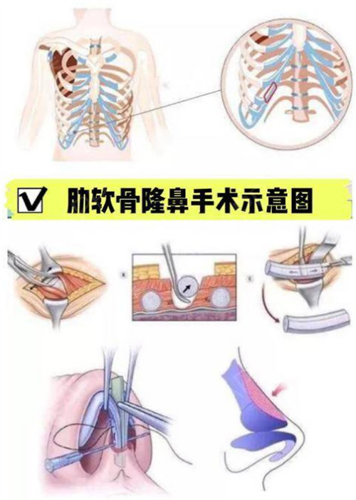 肋骨隆鼻手術(shù)示意圖