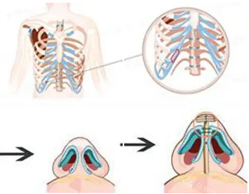 肋骨隆鼻展示圖