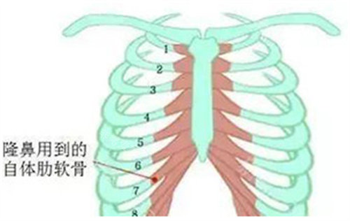 隆鼻用的肋骨圖