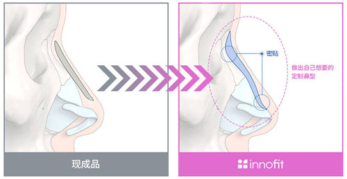 innofit 3D打印鼻整形对比照