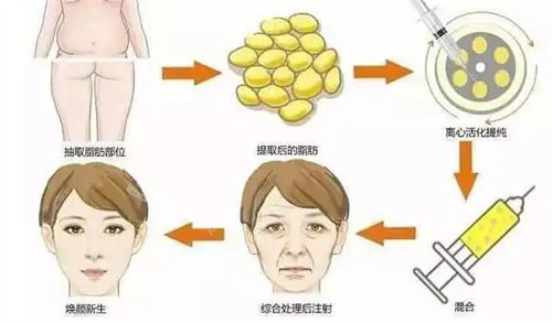 自體脂肪移植流程圖 自體脂肪移植流程圖