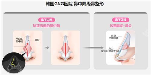 GNG醫(yī)院鼻中隔整形圖示 GNG醫(yī)院鼻中隔整形圖示