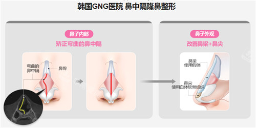 GNG医院鼻中隔整形图示