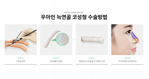 韩国优雅人做鼻子整形手术动画图解
