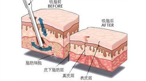 吸脂前后脂肪層變化圖 吸脂前后脂肪層變化圖