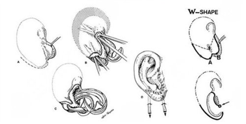 全包法耳再造方法图