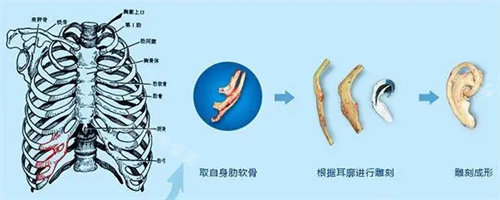 耳再造流程图 耳再造流程图