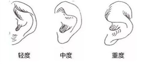 耳畸形不同情况参考图 耳畸形不同情况参考图