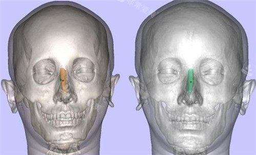 3d隆鼻设计图